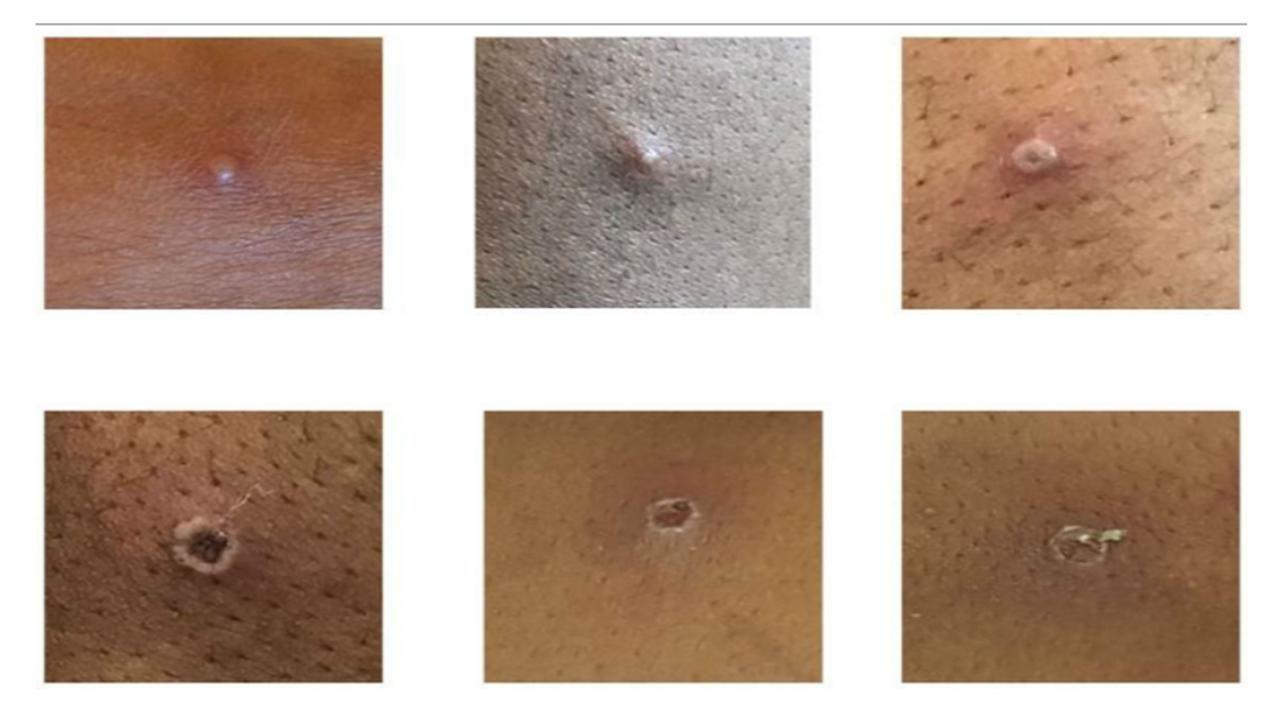 Anvisa sugere máscara e isolamento para adiar chegada de varíola dos macacos no Brasil