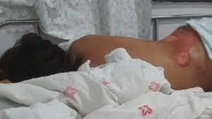 Aluna sofre fraturas após cair e ser arrastada por transporte escolar ilegal